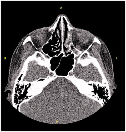 Figure 10. The axial section shows opacification and atelectasis in the left ethmoid sinuses.