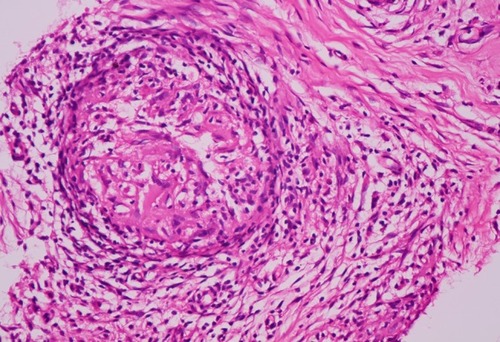 Figure 5 Case 2. CT-guided percutaneous lung biopsy shows plentiful infiltration of epithelioid cells and lymphocytes. Hematoxylin and eosin, ×400.
