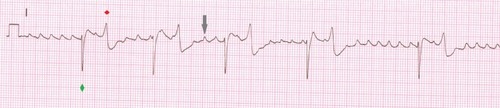 Figure 1 Electrocardiogram recorded from a horse in atrial fibrillation.