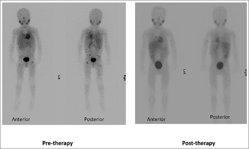 Figure 2. Complete response to protocol therapy in a 6-year old male with chemorefractory high-risk stage 4 neuroblastoma after 2 cycles of therapy at NK-cell dose level 3. Pre-therapy 123I-MIBG scan showed uptake in multiple skeletal areas including pelvis, bilateral femora and spine. Post-therapy 123I-MIBG scan showed complete resolution of skeletal uptake. Complete response was also noted on bone marrow histology.