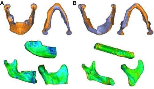 Figure 4 Superimposition of the actual postoperative situation on its preoperative virtual plan for the neomandible, segmented flap, and left and right mandible with color gradient.