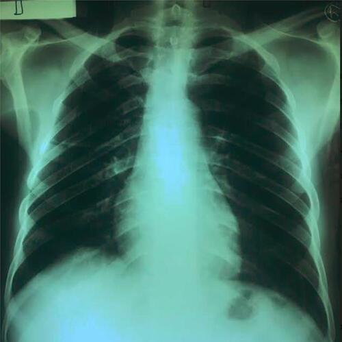 Figure 1 Normal chest X-ray. Histology of the left testis.