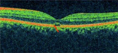 Figure 15 Solar retinopathy showing disruption of photoreceptor ISel band with intact ELM (red arrow).
