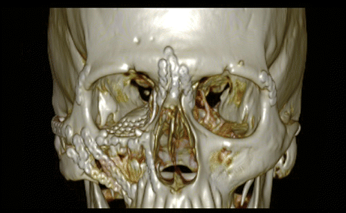 Figure 12. A 3D CT scan showing good repositioning of the fractures as well as the orbital and medial orbital wall reconstruction using a preformed titanium mesh.