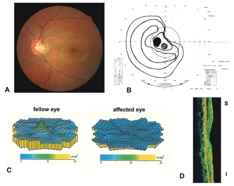 Figure 4 Case 2 Findings in a 29-year-old woman with AZOOr at onset. A) Nearly normal fundus photograph of posterior pole of the left eye. B) Dense superior visual field defects. C) Topographic map of multifocal ERGs showing markedly reduced responses in the macular area. D) Time-domain optical coherence tomography image showing a reduction of the outer nuclear layer.