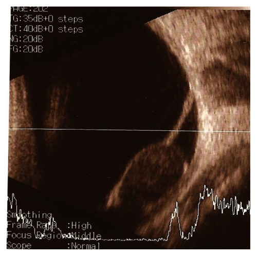 Figure 3 Repeat ultrasound scan of left eye (1 week later).