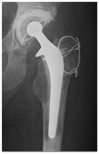 Figure 1. X-ray showing translucency surrounding the femoral component of the prosthesis. Aspirate was negative for infection. Subsequent analysis of the acetobulum proved positive for Actinomyces israelii.