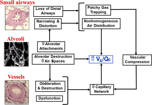 Figure 2. Putative mechanisms by which the structural abnormalities associated with COPD development may increase alveolar ventilation (V̇a)/capillary perfusion (Q̇c) relationship, increasing the wasted ventilation in the physiological dead space. The relative contribution of these abnormalities vary substantially amongst patients with similar spirometric findings justifying the use of more elaborated pulmonary function tests in addition to imaging to improve disease phenotyping. Reproduced, with permission of the American Thoracic Society. Copyright © 2023 American Thoracic Society. All rights reserved. Neder [Citation43]. Annals of the American Thoracic Society is an official journal of the American Thoracic Society.