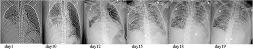 Figure 2 Chest radiograph of the patient during hospitalization.