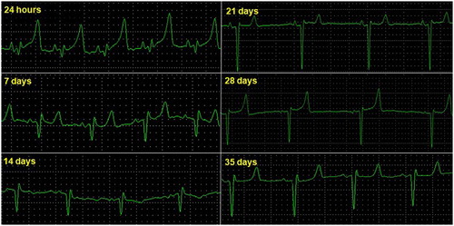 Figure 2. Electrocardiographic tracing of lamb 20, deriving DII, frontal, and birth (24 h) at 35 days of age (25 mmseg, N).