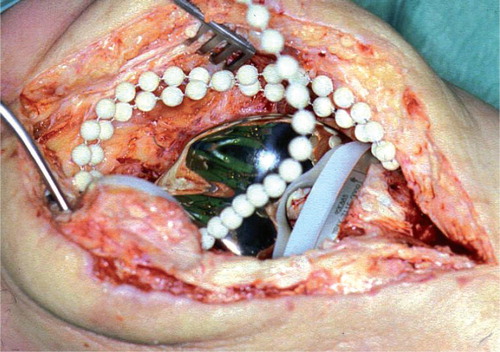 Figure 1. Gentamicin-PMMA beads (Septopal) inserted in a total knee replacement after debridement with retained prosthesis. Beads are mainly placed in the suprapatellar bursa and are removed after 2 weeks by another operation under general anesthesia, but with a smaller incision.