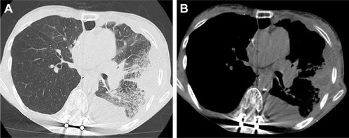 Figure 1 Computed tomography of the chest before treatment of pembrolizumab. Left pleural effusion, left hilar lymphadenopathy, and left lower tumor were observed (A and B).