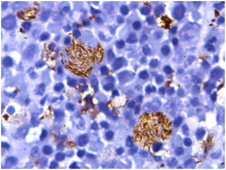Figure 5. Immunohistochemistry for CD68 highlights the fibrillary cytoplasm of the pseudo-Gaucher cells (diaminobenzidine-based staining with hematoxylin counterstain, ×1000).