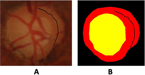 Figure 1 Fundus image of an optic disc (A) showing peripapillary atrophy wrongly annotated as being part of the neuroretinal rim in the original ground truth (B).