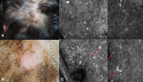 Figure 12 Desmoplastic melanoma on the scalp of a 68-year old woman. (A) Clinical appearance of the dome-shaped melanotic papule, with surrounding brownish macule. (B) The dome shaped papule corresponds to the invasive desmoplastic component, the brown-greyish macule with pseudo network corresponds to the lentigo maligna component. (C) RCM image highlighting the presence of atypical melanocytes (red arrows).