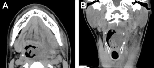 Figure 2 CT before tracheal intubation showing pharyngolaryngeal edema from the left submandibular gland to the epiglottis.