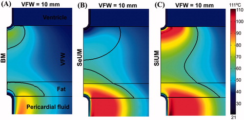 Figure 6. Temperature distributions after 120 s of RFA across the VFW (10 mm wall thickness) with the epicardial catheter placed over a fat tissue layer, considering three modes of ablation: (A) bipolar mode (BM), (B) sequential unipolar mode (SeUM), and (C) simultaneous unipolar mode (SiUM). The solid black line is the thermal damage border (Ω = 1).