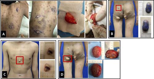 Figure 3 Medical intervention of EC. (A) Conventional wide excision technique for the ECs on the back. (B–D). Minimal excision technique for the ECs on the chest and gluteal regions.