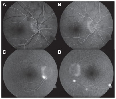 Figure 5 (A, B) Early phase fluorescein angiogram demonstrates hyperfluorescence within temporal disc optic, with appearance in mid-phase and late phase of multiple pinpoint foci of hyperfluorescence (C, D).