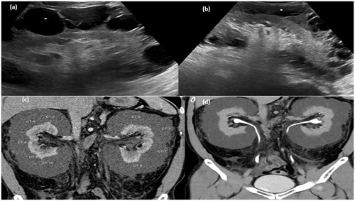 Figure 3. Gray-scale ultrasound image of right kidney (a) and left kidney (b) showing multiseptated anechoic collection (asterisk) in perinephric region. (c) CT scan arterial phase in coronal plane showing multiseptated nonenhancing collection with average HU density 0–10 HU. (d) MPR reformation of coronal plane of delayed phase of CT scan abdomen showing normal excretion of contrast.