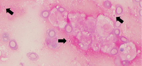 Figure 2 Gram-stain of bronchoalveolar lavage. Black arrows indicate capsulated Gram-negative large rod.