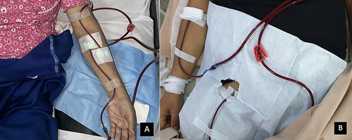 Figure 6 Cannulation of the AVF and the CFV: (A) The cannulation of the AVF, the outflow (red) placed on the proximal draining vein, and the inflow (blue) placed on the distal draining vein; (B) The cannulation of the CFV, the outflow (red) placed on the CFV, and the inflow (blue) placed on the cephalic vein.