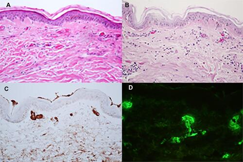Figure 2 Histopathological and direct immunofluorescence findings: (A) Superficial perivascular infiltration with lymphocytes, neutrophils, nuclear dusts, and extravasated red blood cells, with superficial vascular lumen occlusions. (B) Positive Periodic acid–Schiff (PAS) staining in vessel lumens and vessel walls. (C) Positive IgM staining in vessel lumens and vessel walls. (D) Granular deposition of C3 in superficial vascular walls.