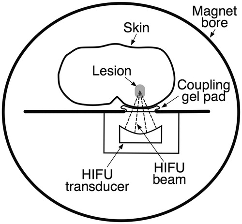 Figure 1. Simplified cross-sectional image of an MRI-guided focused ultrasound (MRgHIFU) system. The tissue between the HIFU beam focus within the target lesion and the HIFU transducer remains undamaged, as does the tissue distal to the target lesion. A temperature map within the target region can be obtained in near-real time in multiple imaging planes.