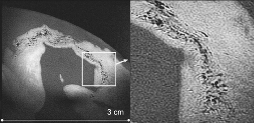 Figure 1. Myocardial infarction in a pig model at 3T. A 100 µm slice with an in‐plane resolution of 60 µm × 60 µm collected at 3.0 Tesla from an infarction on a baseline pig without labeled myoblasts injected. The darker signal intensities detected in the infarcted myocardium reveal blood byproduct accumulation (hemosiderin). Hemosiderin causes signal loss from increased susceptibility effects similarly as SPIOs do, therefore, it is difficult to distinguish one from the other. Healthy myocardium shows with uniform signal intensity.