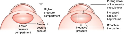 Figure 1 Posterior capsule barrier and hypothesis of the non-fluttering flap.