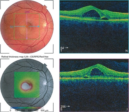 Figure 2 OCT retinal thickness map and horizontal high-resolution images of the right eye showing central serous chorioretinopathy.