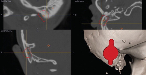 Figure 1. 3D slicer reconstruction visualizes recommended location of the transducer (red) in the right mastoid (bottom, right). CT scan images show the sagittal (top, left), axial (top, right), and coronal (bottom, left) views with the transducer position (red lines) that is closely located on the sigmoid sinus.