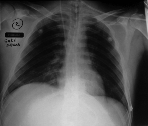 Figure 2: The chest X-ray after the operation