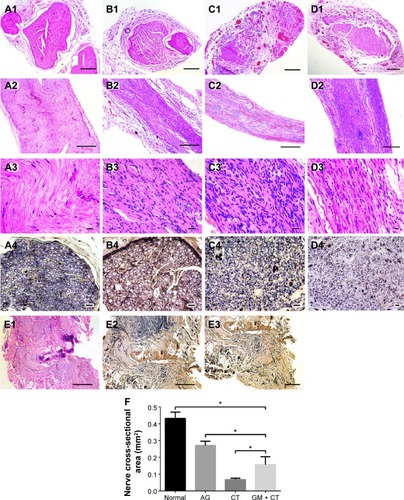 Figure 6 Histology of regenerated nerves for HE staining and Loyez staining under light microscopy at 20 weeks postoperation.Notes: (A) Normal group. (B) AG group. (C) CT group. (D) GM + CT group. (E) BLANK group. (A1–D1) HE staining of transverse sections of midsection of regeneration nerve. (A2–D2, A3–D3, and E1) HE staining of longitudinal histology of regenerated nerves. (A4–D4 and E2, E3) Loyez staining. (E3) Neuroma formed at the end of the proximal stump (bar in [A1–D1] and [E3] =200 μm; bar in [A2–D2] and [E1 and E2] =500 μm; bar in [A3–D3] =20 μm; bar in [A4–D4] =10 μm). (F) Statistical analysis of the nerve cross-sectional area *P<0.05.Abbreviations: HE, hematoxylin–eosin; AG, autograft; CT, collagen tube; GM + CT, collagen tube filled with GDNF-loaded microspheres; GDNF, glial cell-line derived neurotrophic factor.