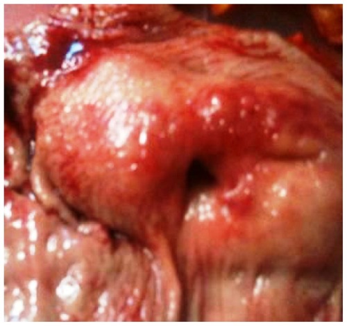 Figure 3 Gastrointestinal stromal tumor surgical specimen.