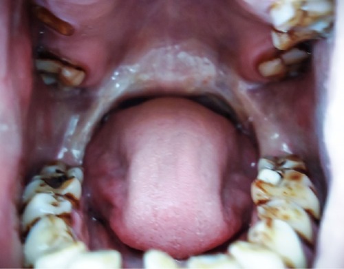 Figure 5 Blanching present on soft palate of patient with oral submucous fibrosis.