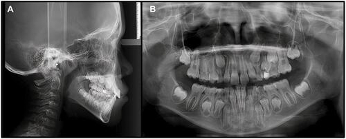 Figure 4 Panoramic dental X-ray. (A) Lateral view. (B) Panoramic dental X-ray shows dental crowding especially from the first and second superior premolars until the superior molars.