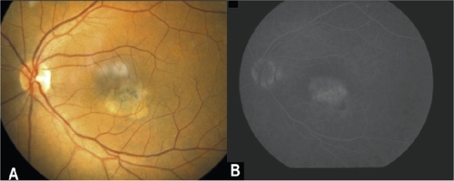 Figure 4 A) Left eye: Color fundus picture following ranibizumab treatment revealing significant improvement with no subretinal hemorrhage. B) late venous phase of FA of the LE showing minimal leakage due to telangiectasis but no signs of active neovascular membrane.
