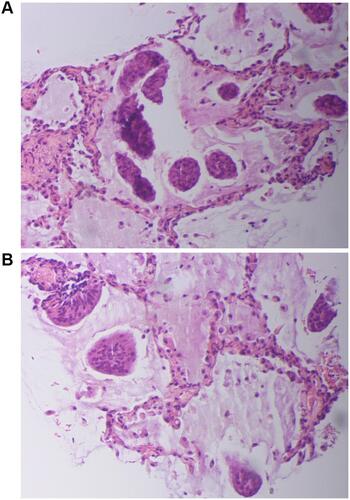 Figure 2 Percutaneous lung biopsy specimen from tumor lesions (A and B, hematoxylin–eosin). Pathology showed a lot of mucus filling the alveolar space.