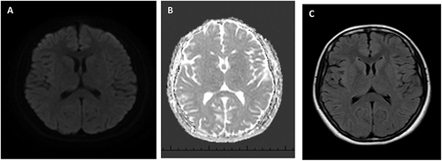 Figure 2 (A-C) control MRI showing resolution of the diffusion restriction seen in the initial MRI after the disappearance of the patient’s weakness.