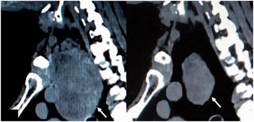 Figure 2. Example of CT scans before (left) and 6 months after (right) the last laser treatment. The thyroid nodule is indicated by the white arrows.