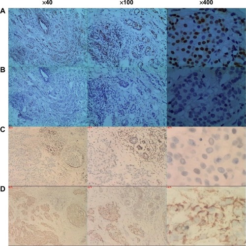 Figure 1 Representative examples of immunohistochemical analysis of p27 and p-p27ser10 in breast invasive ductal carcinomas and adjacent tissues.