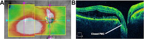 Figure 2 Six weeks after vitrectomy and C3F8 tamponade. (A) Composite OCT topography. (B) OCT cross-section image showing pit-macula communication closed (4/8/15, CMT 501 microns, Volume 15.3 mm3).Abbreviations: OCT, optical coherence tomography; CMT, central macular thickness.