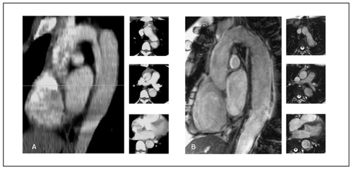 Figure 1 A. Sagittal view of a contrast enhanced computed tomography scan showing a native type B aortic dissection in a young Marfan syndrome patient; the 3 pictograms in axial view identify a small true lumen and a larger false. B. Gd-enhanced MR tomogram in sagittal orientation; Follow-up study one year after endovascular stent-graft placement showing no resident false lumen and reconstruction of the dissected aorta as confi rmed on axial pictograms.
