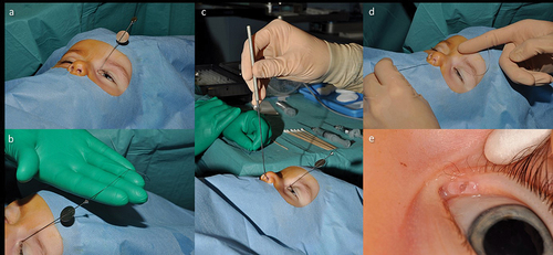 Figure 7. Monocanaliculonasal intubation in an 18-month-old child (left eye).