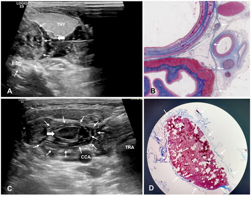 Figure 3. Ultrasound Image of hydrodissected TGS and CPS and the pathological images. (A) The TGS (white thin arrows) shows as a semicircular multilayer mixed-echoic area. (B) Pathological image shows corresponding fascia (white thin arrows) distribution in the tracheoesophageal groove area. (C) The CPS (white thin arrows) shows as an annular multilayer mixed-echoic area around SHPT lesion (white thick arrow). (D) The MASSON stains of resected SHPT lesion showed there were several layers of circular distributed collagen fibers (white thin arrows) around SHPT lesion (white thick arrow). Note: THY, thyroid; ESO, esophagus; TRA, trachea; CCA, common carotid artery; IJV, internal jugular vein; CPS, circumferential periparathyroidal space; TGS, tracheoesophageal groove space.