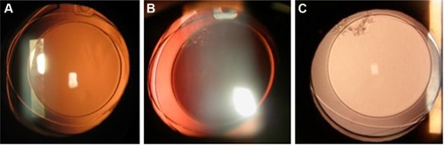 Figure 3 The slit-lamp retroillumination photos of peripheral PCO development at the ring gap in the same eye at 3 (A), 12 (B), and 36 (C) months postoperatively.