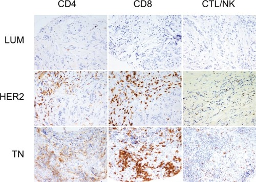 Figure 1 Tumor-infiltrating lymphocyte (TIL) subsets in different breast cancer groups.Notes: CD4, CD8 and granzyme-B peroxidase-positive immunohistochemical staining in LUM, HER2 and TN breast cancers: LUM shows a low TIL level in comparison with HER2 or TN. CD8 is the predominant T-cell population. LUM, HER2 and TN are the same case of Figure 2. (200× magnification).Abbreviations: LUM, luminal; HER2, human epidermal growth factor receptor 2; TN, triple negative; CTL/NK; cytotoxic T lymphocytes/natural killer lymphocytes.