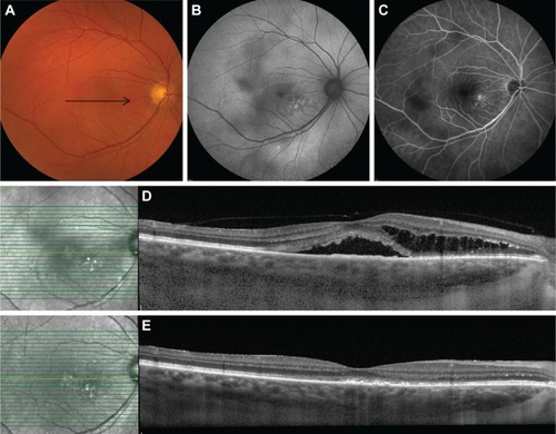 Figure 3 Clinical features on multimodal imaging of the right eye of a 63-year-old female patient with severe chronic central serous chorioretinopathy (A–C). Black arrow on color fundus photography image (A) shows the scanning plane, which is depicted on the SD-OCT scans (D, E). FAF shows multiple speckled hyperautofluorescent changes in the macula together with an irregular surface of hypoautofluorescence, expanding from the fovea to the superior and inferior vascular arcades (B). Fluorescein angiography imaging (C) revealed a limited area of fluorescein leakage with a clear central focus. The areas of hypofluorescence were located more temporal from the fovea and were smaller than on FAF. An SD-OCT scan (D) at first presentation and prior to treatment revealed a subretinal serous fluid accumulation together with a posterior cystoid retinal degeneration in the outer nuclear layer of the retina. At ~2 months after half-dose photodynamic therapy, both subretinal and intraretinal fluid on OCT had resolved completely (E).