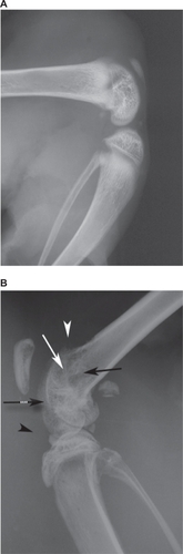 Figure 2 Radiographs of rat ipsilateral hind legs. Radiographs of the ipsilateral hind leg from vehicle (A) and MATLyLu (MLL) cell injected (B) rats displaying structural changes following model induction. Compared to vehicle, the radiograph from the MLL cell injected rat displayed acute osteopenia within the distal portion of the ipsilateral femur involving the distal femoral metadiaphysis (black arrow), metaphysis (white arrow), and epiphysis (black hatched arrow). Also visible in the radiograph of the MLL cell injected ipsilateral hind leg was cortical destruction in the anterior aspect of the metaphysis and metadiaphysis with periosteal reaction (white arrowhead). Joint effusion within the MLL cell-injected ipsilateral femur was also visible in the radiograph (black arrowhead).